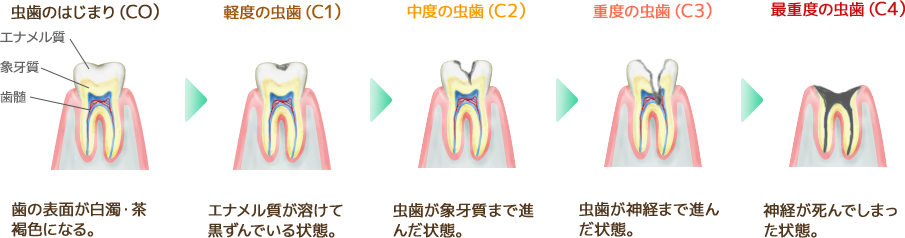 虫歯の進行レベル
