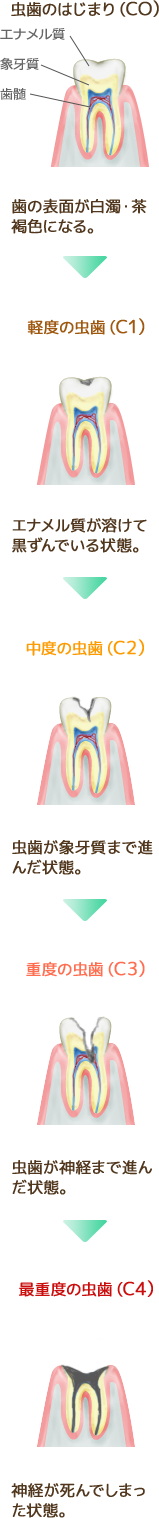 虫歯の進行レベル