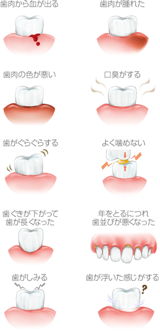 PMTC(プロフェッショナルクリーニング)