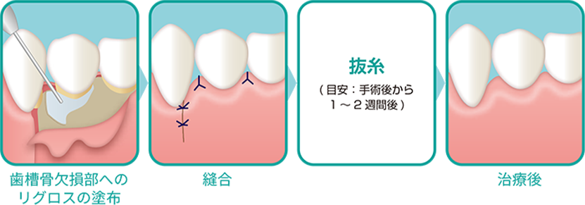 歯肉剥離掻爬術(フラップ手術)